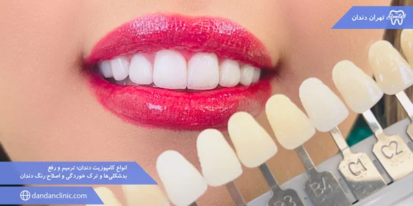 Types-dental-composites